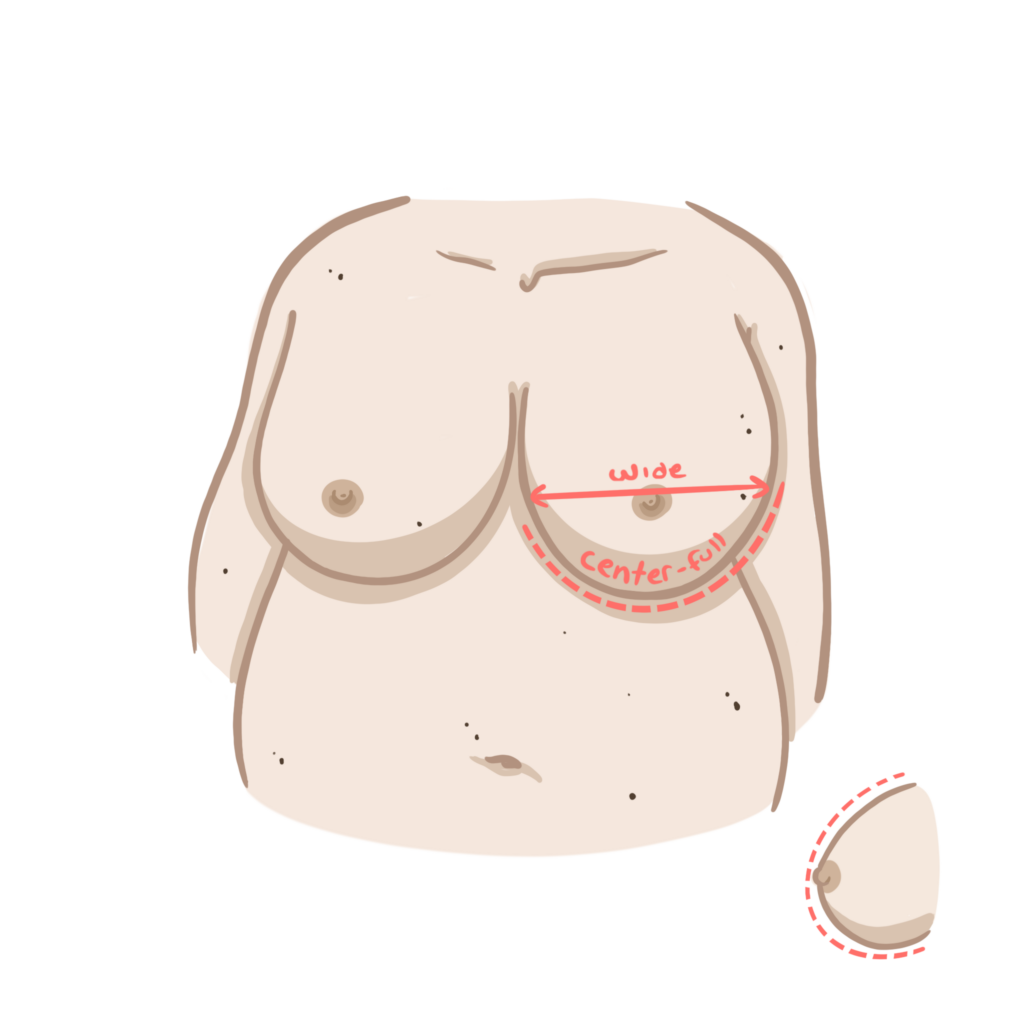 An illustration of Ava's breast shape which is balloon, meaning is round all around